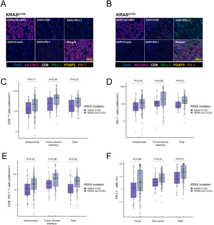 Dissecting the clinicopathologic, genomic, and immunophenotypic correlates of KRASG12D mutated non-small cell lung cancer